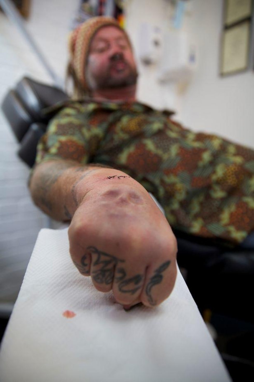 Tattoo-besat mand får opereret et kranie ind i hånden