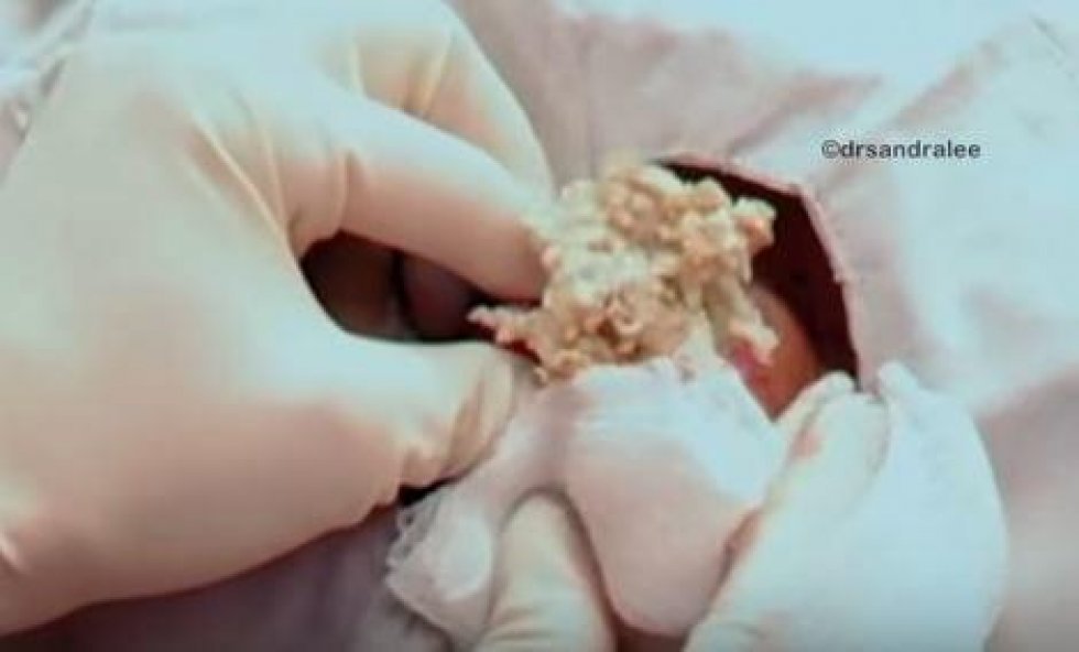YouTube / Dr. Sandra Lee (aka Dr. Pimple Popper) - Når giga-bumsen sprænges vælter det ud med snask der giver selv den mest hårdføre kvalme