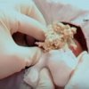 YouTube / Dr. Sandra Lee (aka Dr. Pimple Popper) - Når giga-bumsen sprænges vælter det ud med snask der giver selv den mest hårdføre kvalme