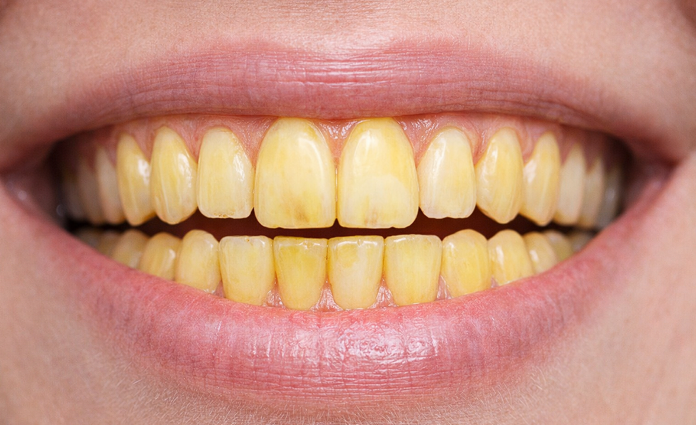 Gule bisser? 6 daglige fejl du (sandsynligvis) begår, der smadrer dit hvide smil