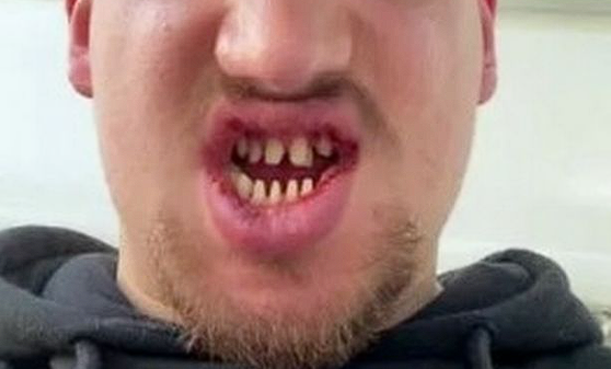 ‘Det ligner firkantet tyggegummi’ Mand mobbes efter, at han har fået lavet nye tænder